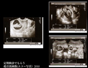 my-ultrasound-picture